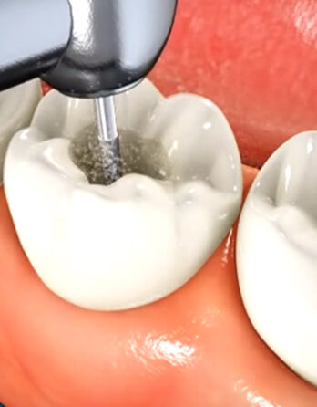 Get To The Root Of Your Dental Issues With Root Canal