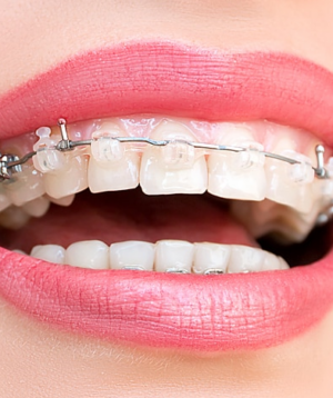 Ceramic Braces