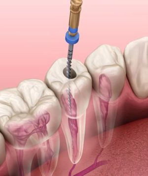 Root Canal Treatment