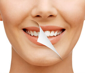 Everything you need to know about Teeth Zoom Whitening…
