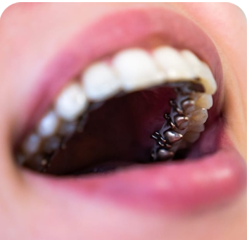 Lingual Braces