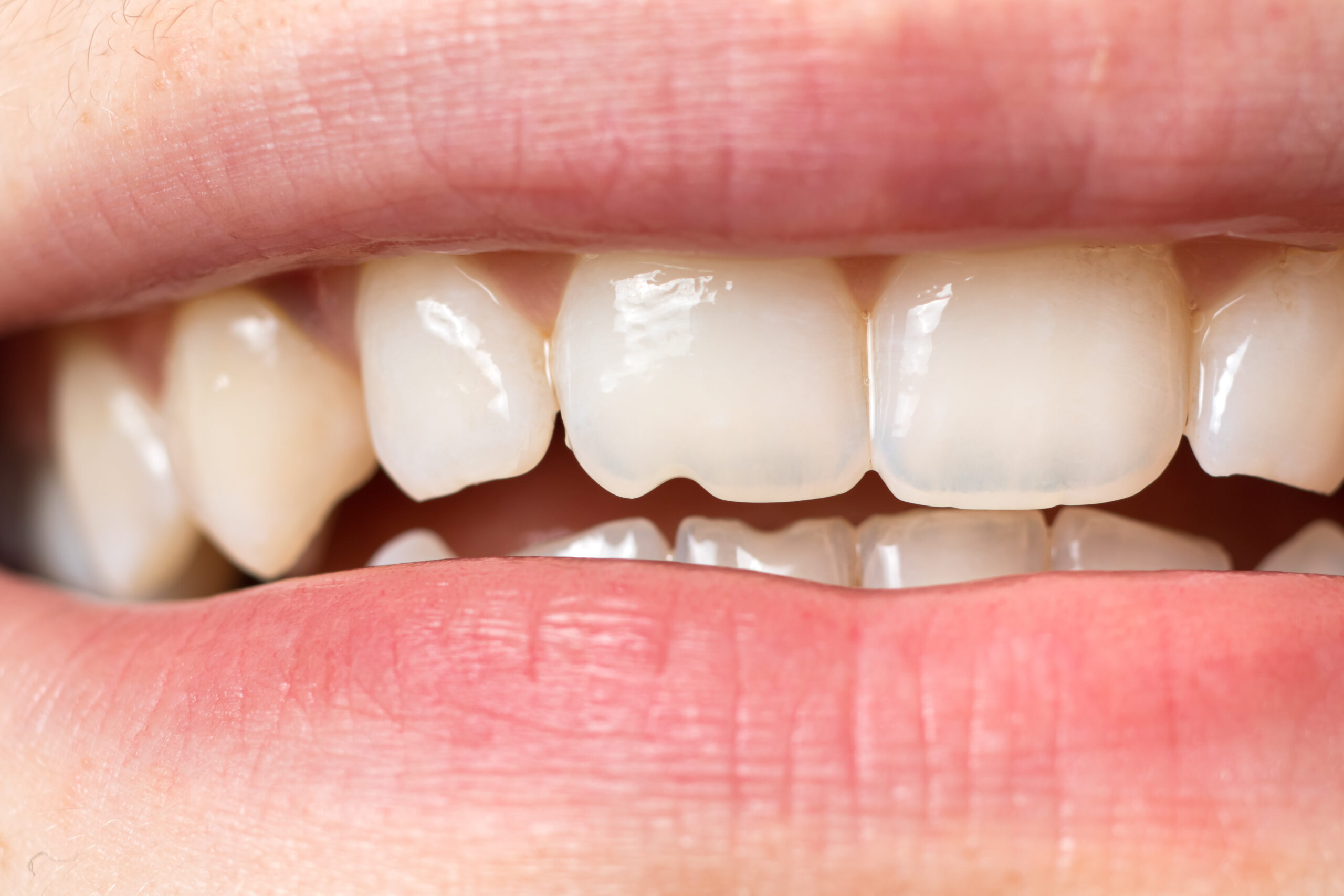 Chipped Tooth: Causes, Symptoms, Treatment and Home Care…