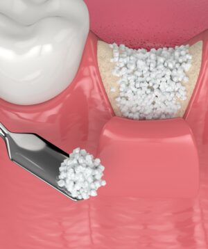 Bone Grafting Surgery