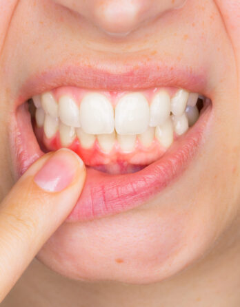 Gum Recession: Signs, Causes & Treatments