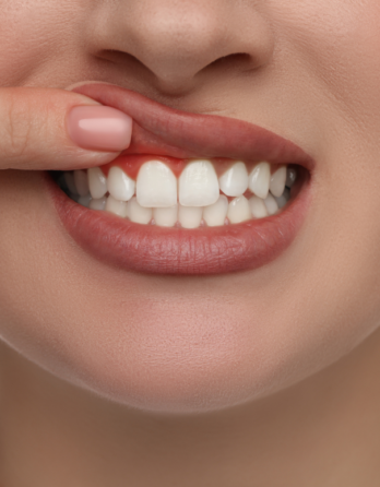 Gum Recession: How to Stop, Treat and Prevent It